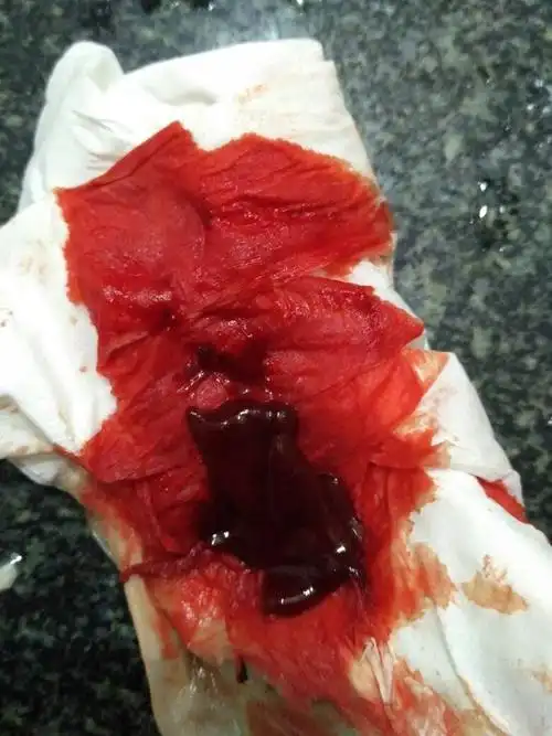 子宫膜厚15mm,来月经都15天了,经量太多了,一天一包卫生巾,晚上也要一