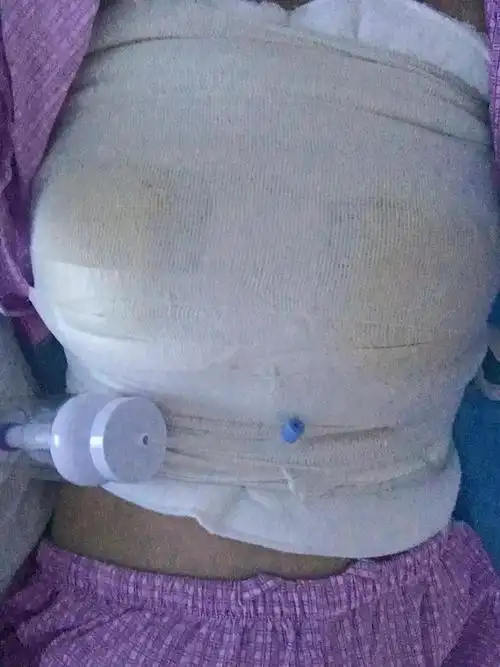 考虑到假体隆胸一次成型又不影响哺乳,终于鼓起勇气做_圈子-新氧美容