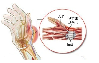大拇指腱鞘炎手大拇指腱鞘炎
