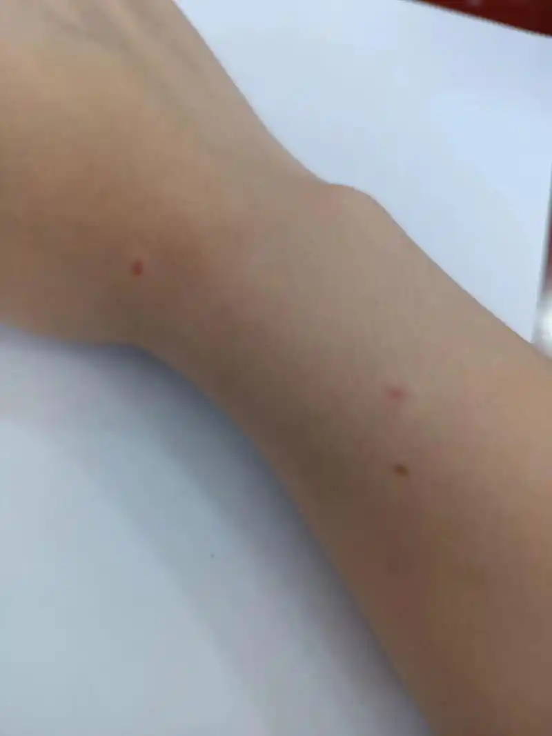 为什么现在蚊子这么毒 睡觉右边胳膊在外面被蚊子咬了十几个包,早上只