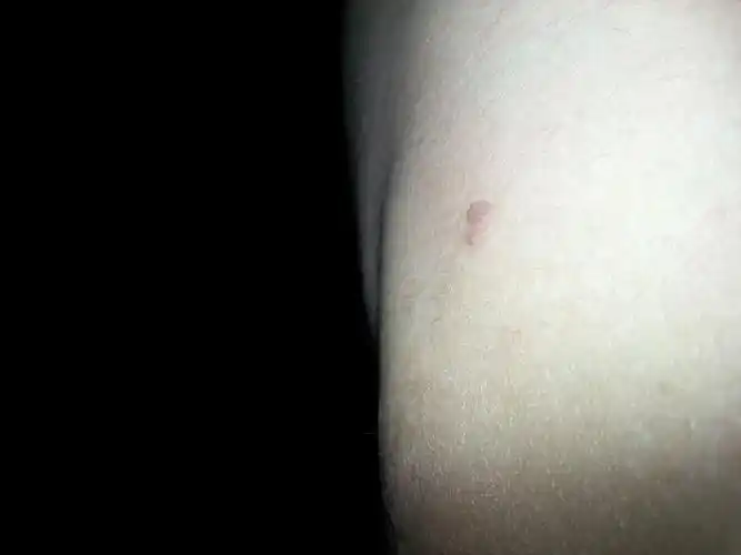 手上长了几个小包不知道是什么