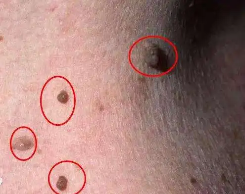 皮肤上长疣,可能是这三种类型,有的没事有的却很严重