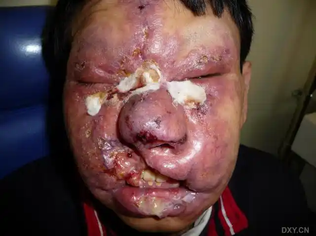 【病例讨论】罕见面部口腔严重溃烂伴肉芽肿形成原因待查 [病例帖]