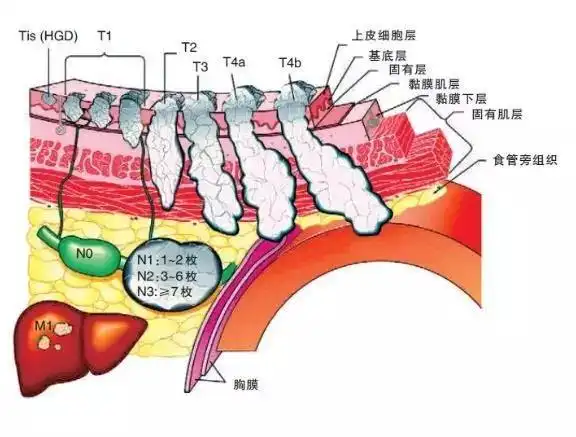 食管分4层,从内而外,有粘膜层,粘膜下层,肌肉层,外膜层.