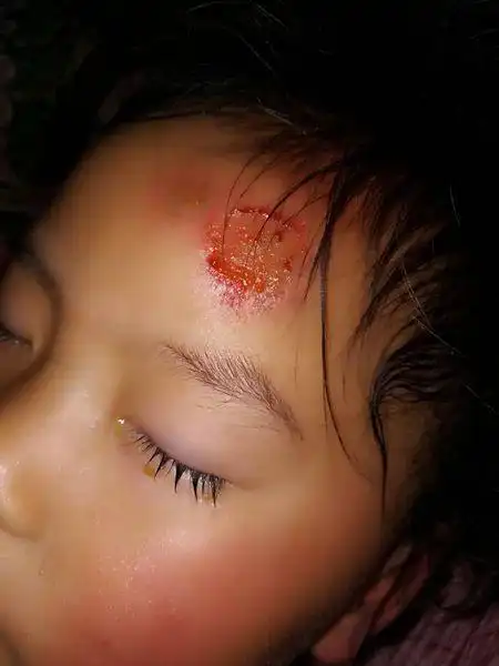 小孩跟小孩之间玩,另外一个小孩把你小孩用自行车额头受伤了会怎么样