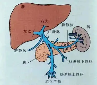 肝癌细胞易侵犯门静脉系统,形成门静脉癌栓(pvtt).