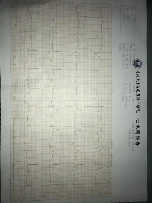 窦性心律,过缓 不齐 是什么原因造成的啊?
