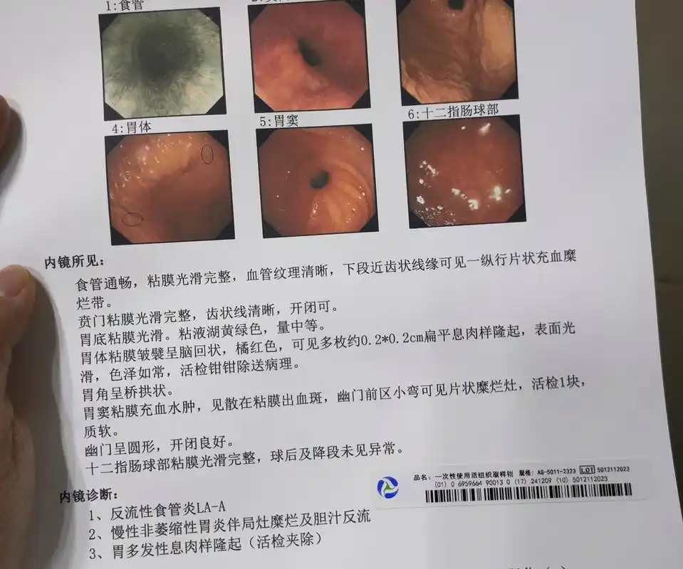 女60岁症状持续半年了,然后最近刚查的胃镜有慢性胃炎,平时胃胀气