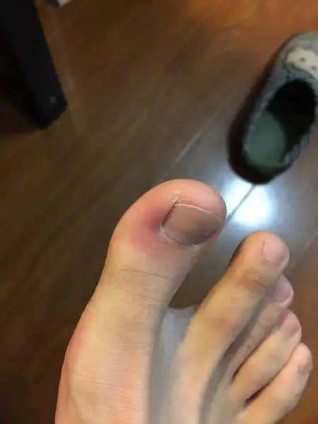 大姆脚趾疼痛,不动不痛,弯曲疼痛不明显,手指按压疼痛明显