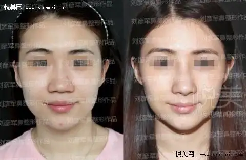 项目大全 隆鼻 前后对比图 > 鼻小柱延长术  0 0