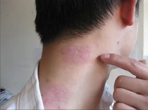 银屑病好转图片_银屑病求医网