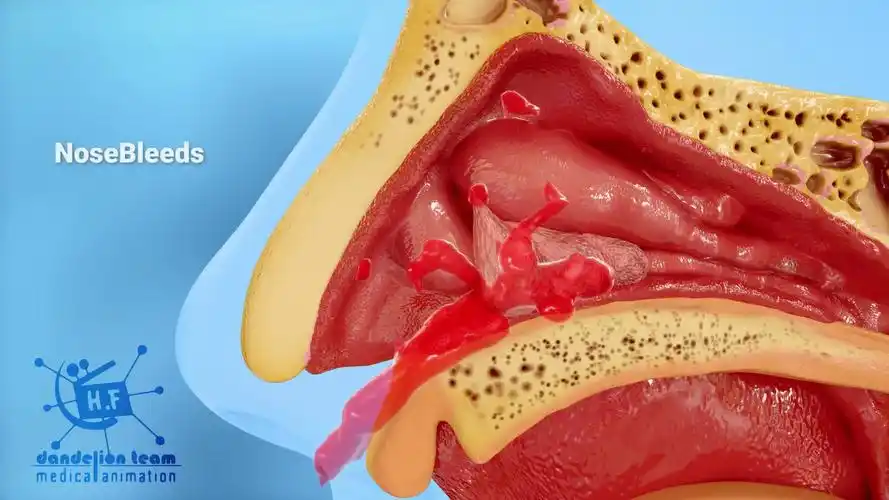 鼻息肉是鼻腔内壁柔软,无痛,非癌性的增生
