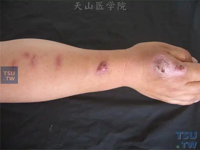 孢子丝菌病(sporotrichosis)的症状表现 - 皮肤病学 - 天山医学院