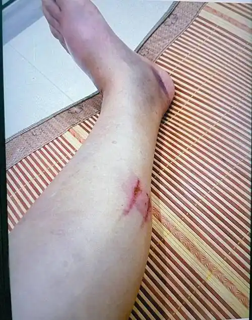 女子小腿磕破皮自行喷药致感染!医生提醒:处理外伤别乱用药