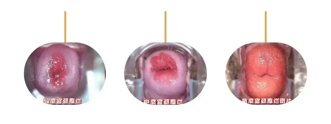 对于女性来说,宫颈的重要性如何体现?要怎么呵护!