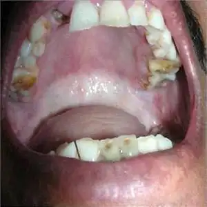 口腔黏膜纤维化