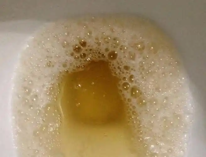 高尿酸伤肾,一旦排尿有三种表现,当心高尿酸走向肾衰竭了