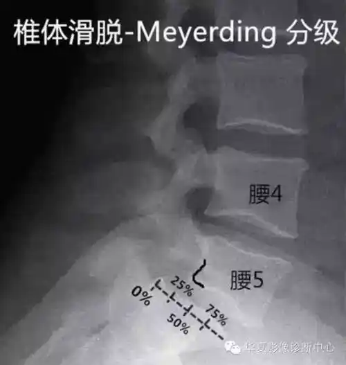 骶椎腰化腰椎骶化腰椎滑脱腰肌劳损