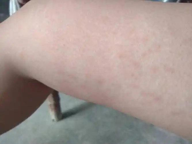 大腿内侧红斑,不疼不痒,今年才发现的