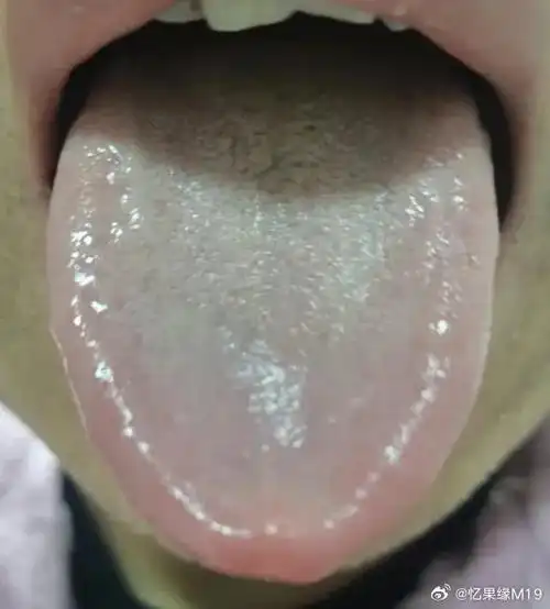 这种舌象典型的:肝郁脾虚,气血两虚,为何用疏肝健脾,养血的逍遥丸无效