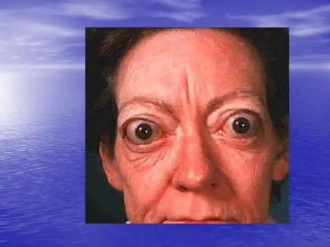 graves眼病的诊断与治疗ppt