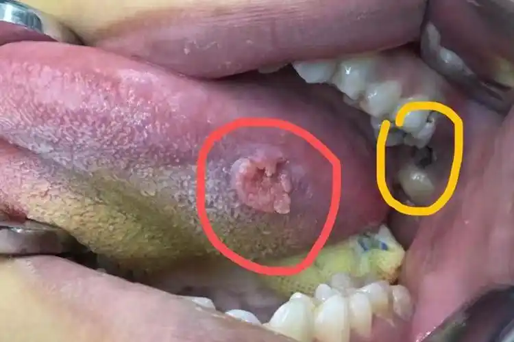 口腔菜花状赘生物图