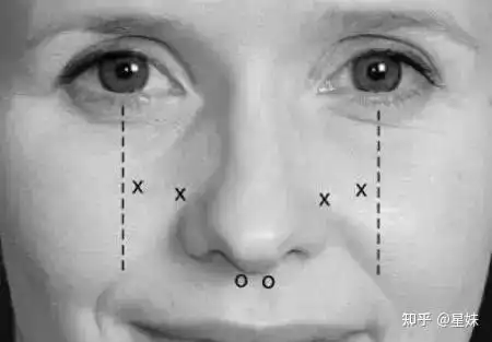 肉毒素祛皱注射方法和分布点位