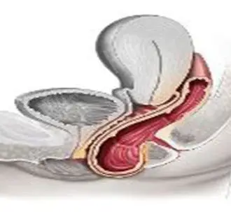 阴道壁膨出不及时恢复的后果与解决方案