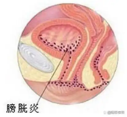 后可转移到右下腹,疼痛多固定于右下腹,并出现典型麦氏点压痛及反跳痛