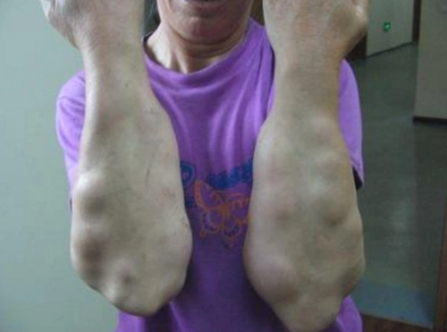 手臂皮下脂肪瘤图片