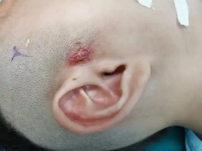 先天性耳前瘘管感染期手术与非感染期手术对比_先天性耳前瘘管_先天性