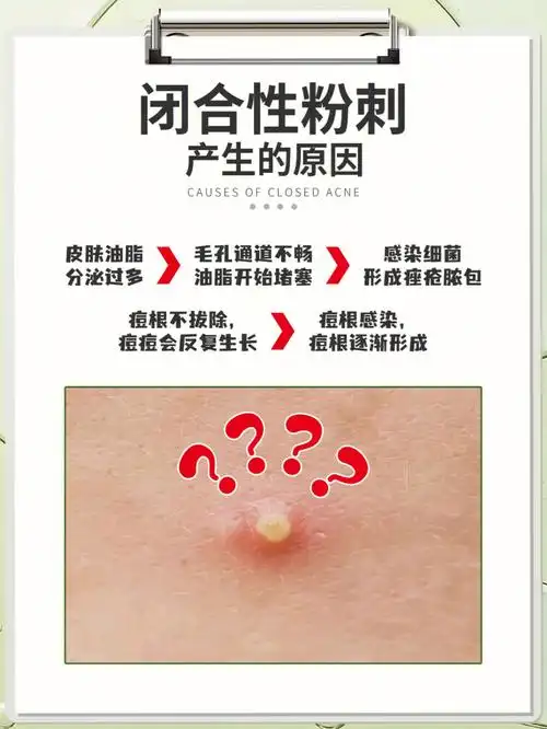 干货分享丨教你闭合性粉刺如何去除
