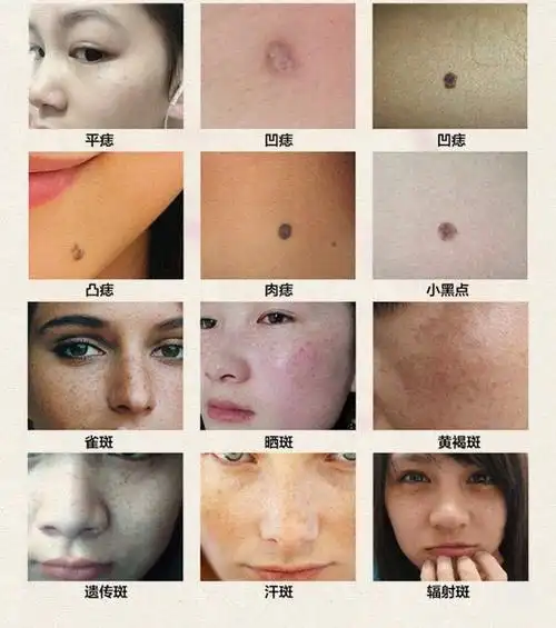 祛i痣雀斑产品点痣药水点斑膏无痕脸部除黑点去i斑去i痣 去痣点痣水祛