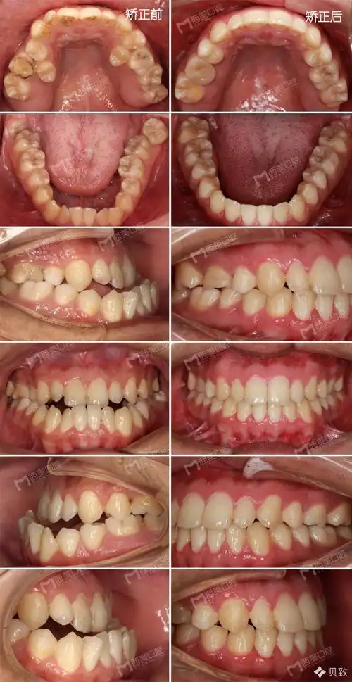 正畸正颌联合矫治案例