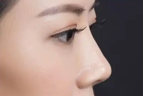 自然无痕韩式假体隆鼻前后对比