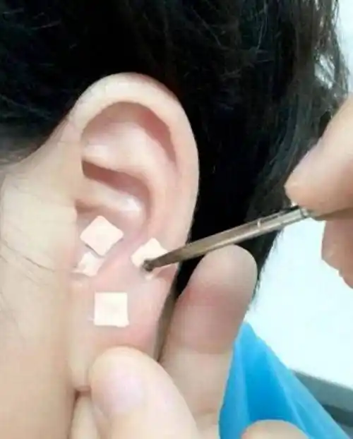 【名院名医】耳穴压豆可以防治近视?答案来了!_青少年_儿童_临床