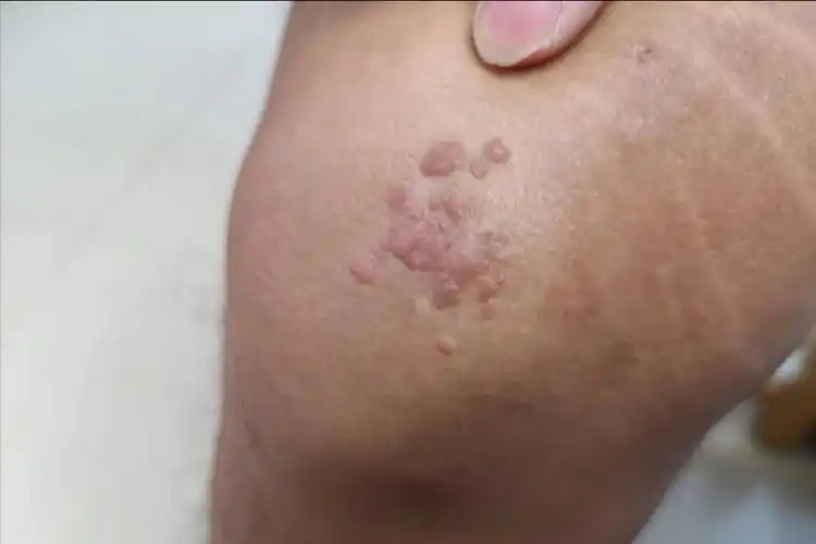 hpv和病毒疣都啥模样?