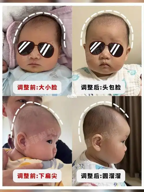 很复杂的头型,宝宝有明显的大小脸,整个头顶右低左高;头顶又是舟状头