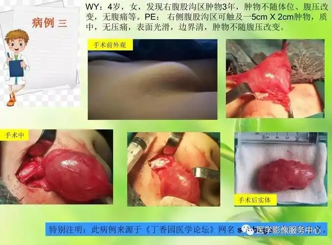 一例女性腹部包块手把手教你如何在ct上做出病理诊断