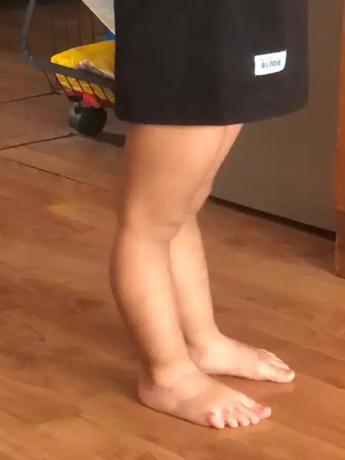 后续来了小朋友膝过伸