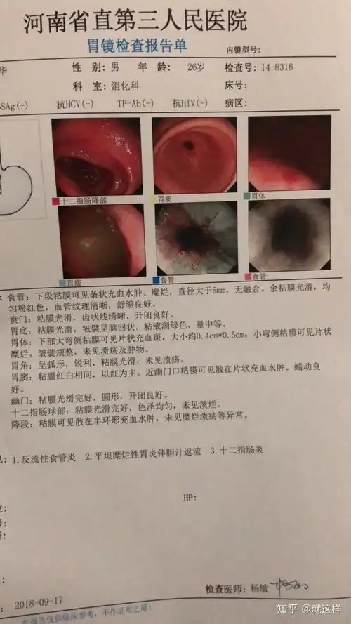 有没有同时得了反流性食管炎慢性糜烂性胃炎伴胆汁回流和慢性结肠炎的