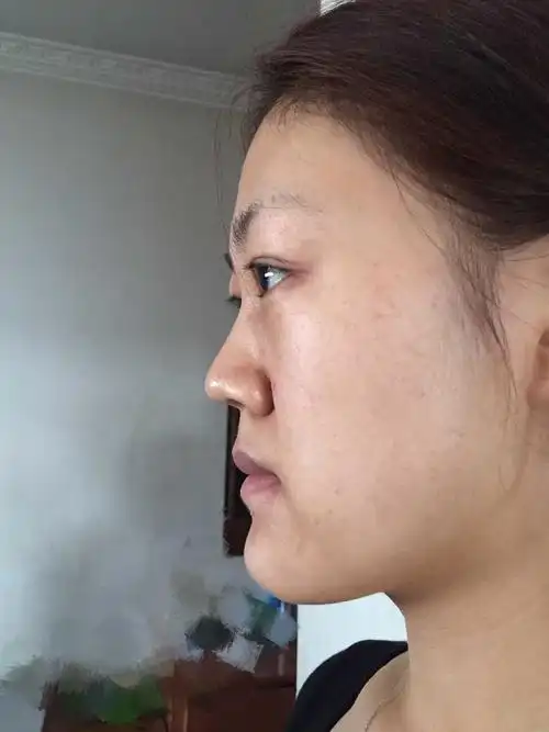 面中凹陷鞋拔子脸整容思路应该怎样