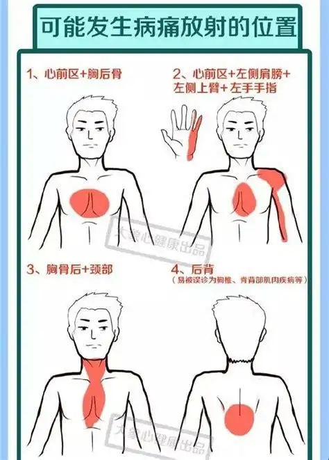 心绞痛发生的典型部位是剑突还是
