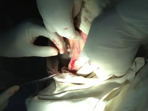 小切口皮瓣修剪法治疗腋臭