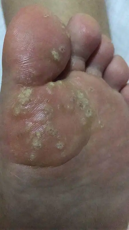 小疙瘩有点硬,热水洗脚时有点痒,平时不痒.