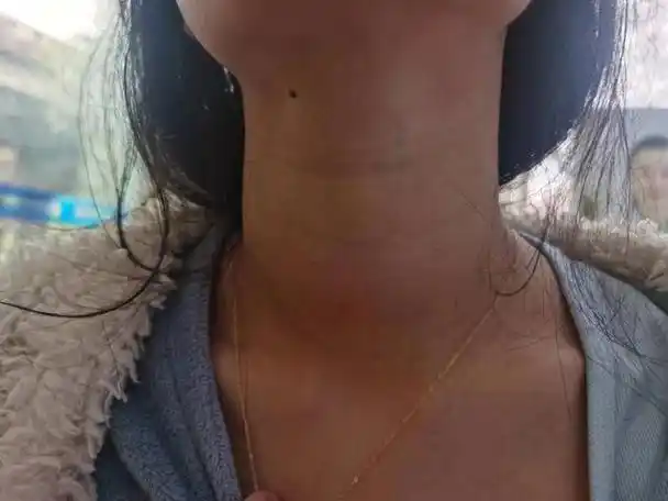 17岁女孩罹患甲亢,2年未治脖子粗大,导致严重自卑心理!