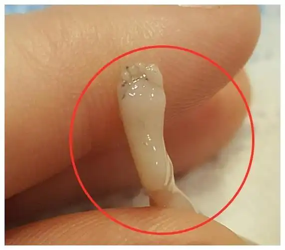 宝妈怀孕14周后流产,分享出胎儿照片,仅10厘米但手脚已经成型