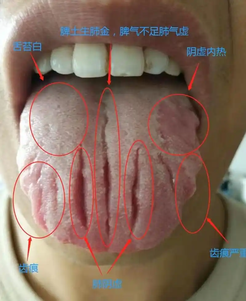 舌头有裂纹怎么办?#健康养生# #肾虚