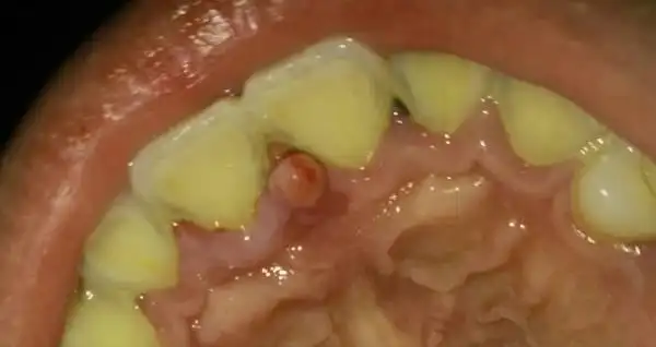 牙齿 上部牙龈上长了个小疙瘩 是硬的 舔它会疼 是怎么回事?有图