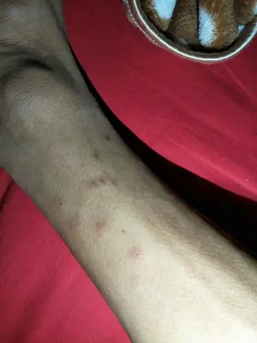 的,痒了几天了痒了大概半个月了,去药店拿药,医生说是皮肤不适应环境